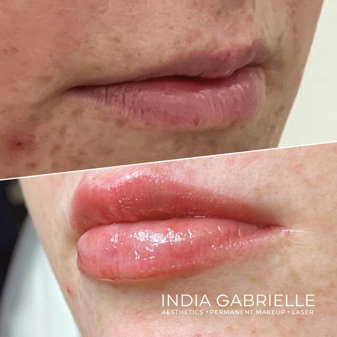 Before and after photo of a client's lips after receiving 1ml Lip Filler by India Gabrielle. 