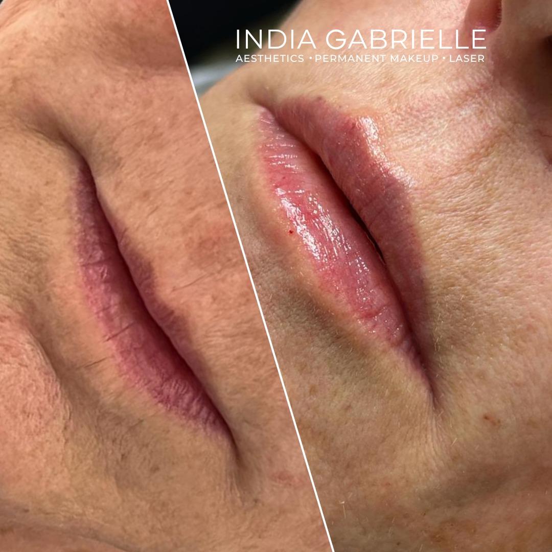 Before and after photo of a client's lips after receiving 1ml Lip Filler by India Gabrielle.