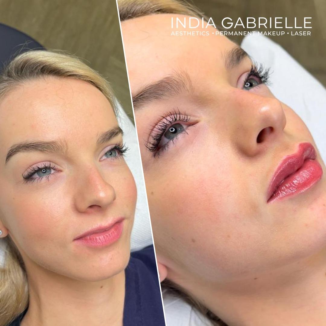 Before and after photo of a client's lips after receiving 1ml Lip Filler by India Gabrielle.