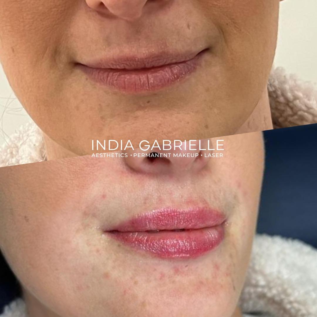 Before and after photo of a client's lips after receiving 0.7ml Lip Filler by India Gabrielle.