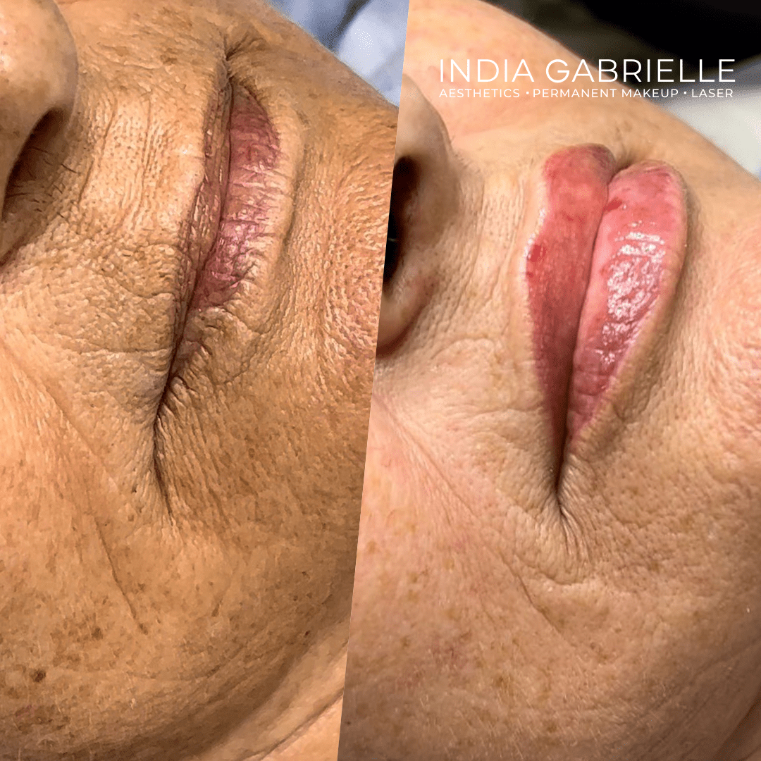 Before and after photo of a client's lips after receiving 1ml of Lip Filler by India Gabrielle. 