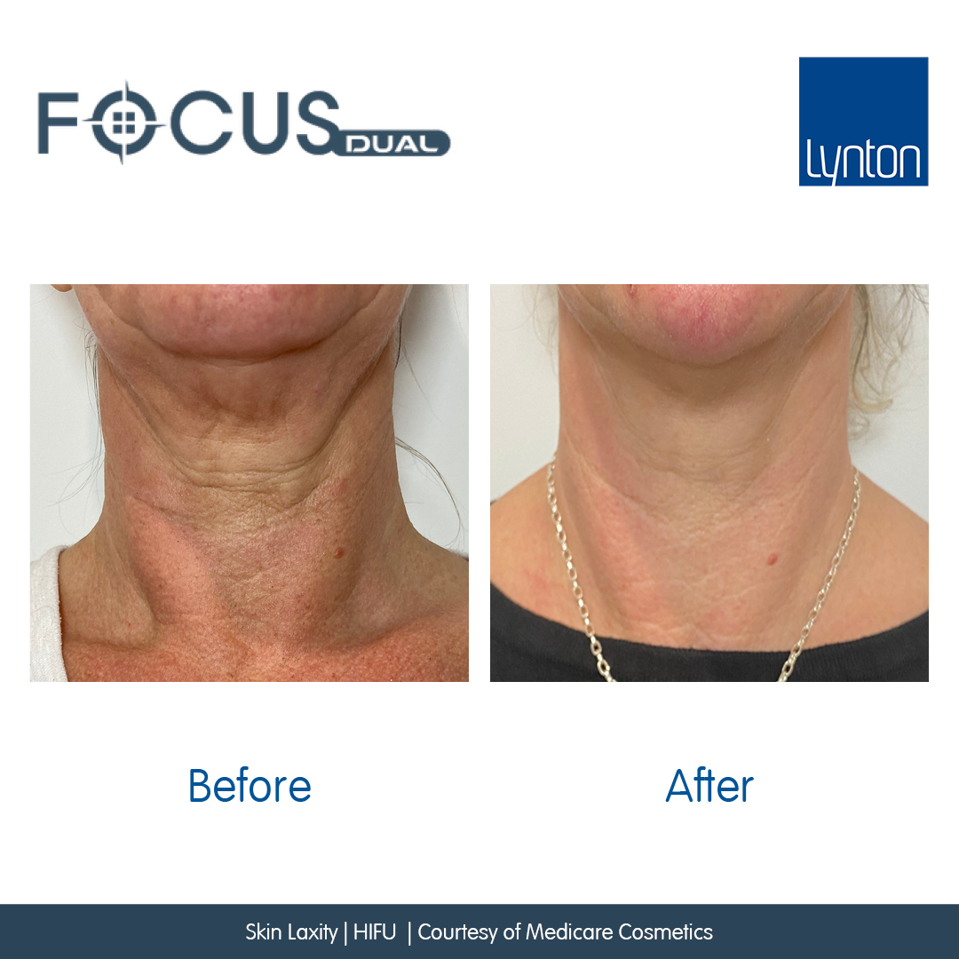 Neck- before and after one Lynton Focus Dual High Intensity Focused Ultrasound treatment. 