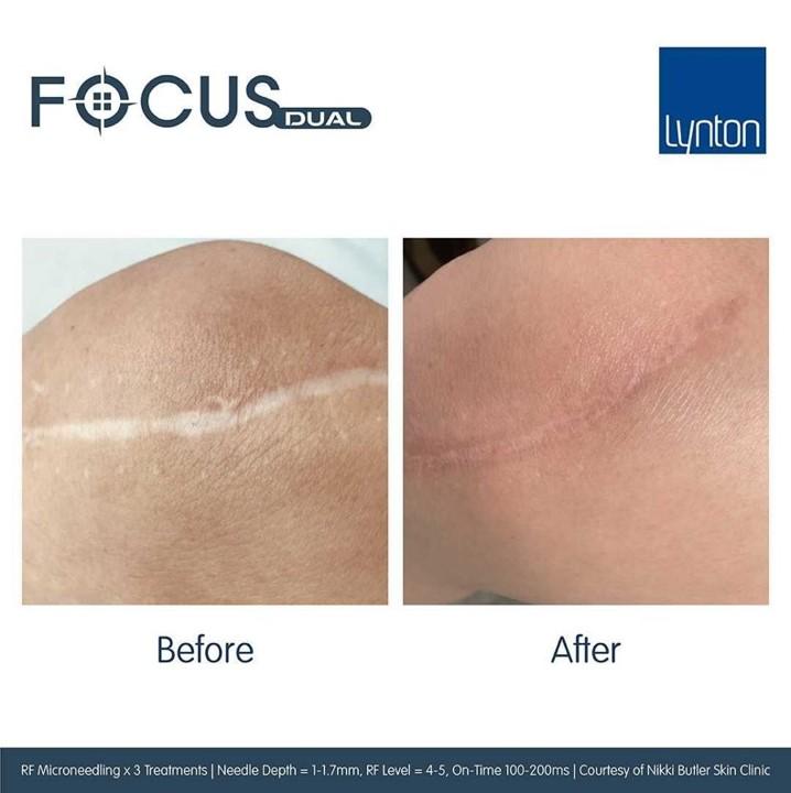 Before and After - Lynton Focus Dual Radio Frequency Microneedling