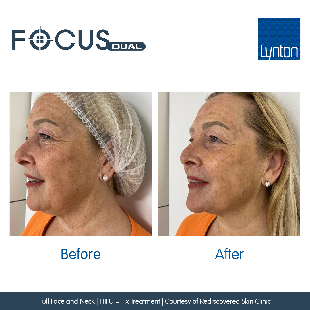 Full Face and Neck- before and after one Lynton Focus Dual High Intensity Focused Ultrasound treatment. 