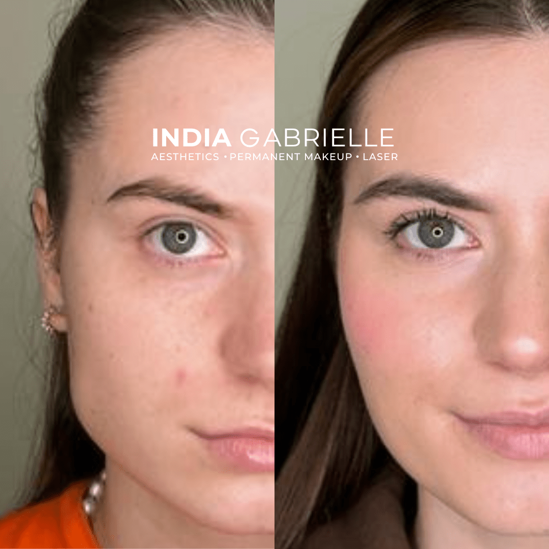 Masseter Botox - India Gabrielle 